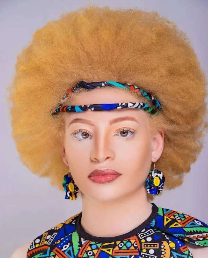 MissAlbinism1